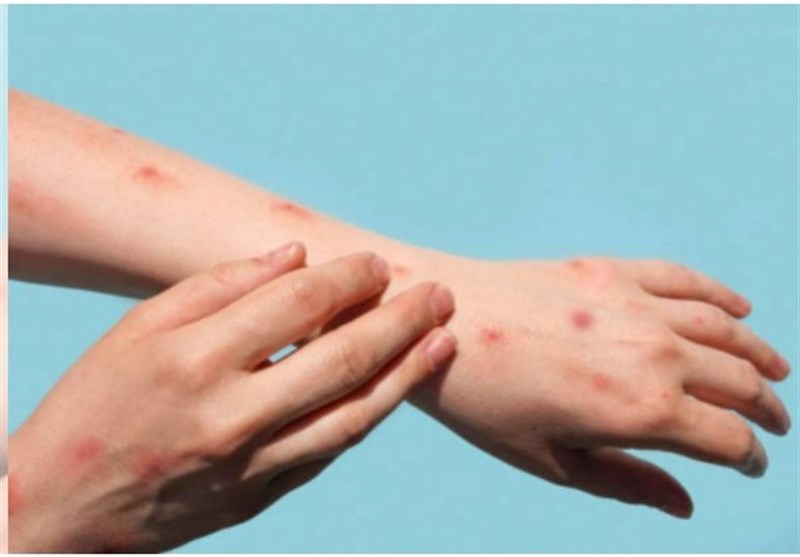 Monkeypox