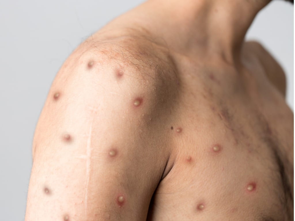 آبله میمون چیست 3 Monkeypox