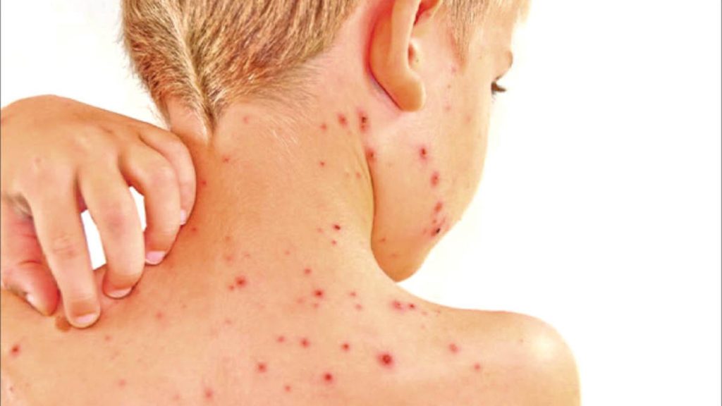 عکس آبله میمون در کودکان