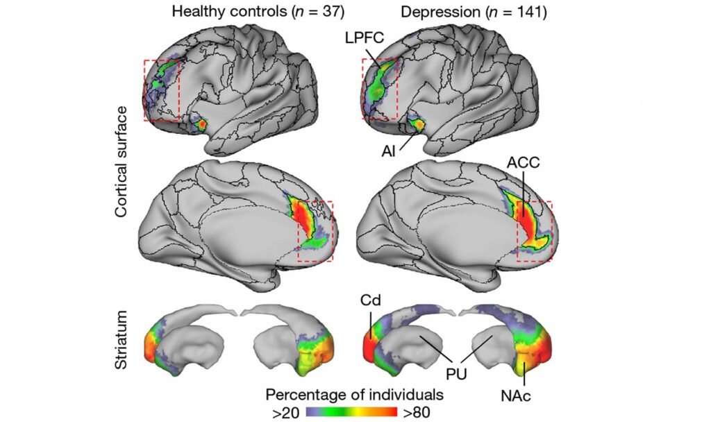 بخشی از مغز افراد مبتلا به افسردگی زیاد بزرگ‌تر از دیگران است_اصفهانیا