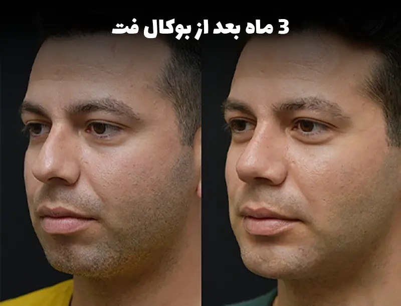 سپس از جراحی چانه، چه کارهایی انجام بدهیم؟ (مراقبت‌های سپس بوکال فت)