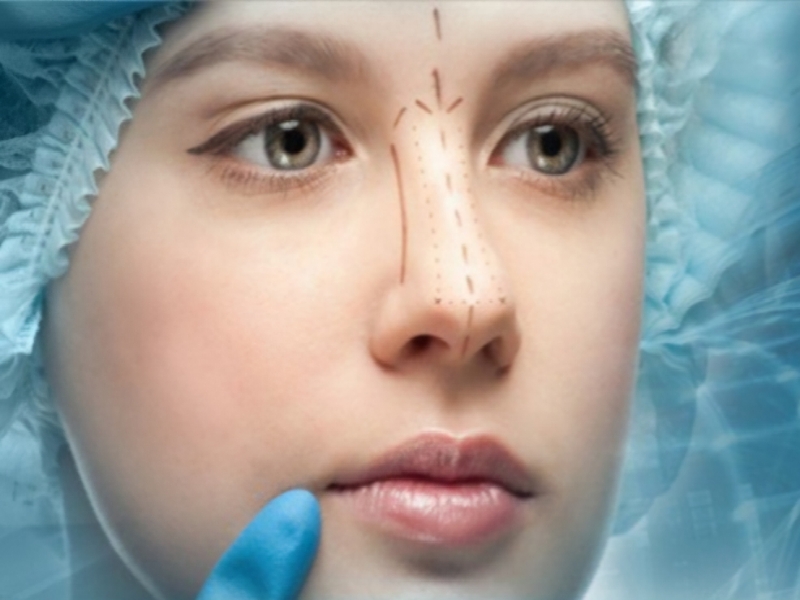 چند نوع عمل زیبایی بینی داریم؟ 6 12aee7d1-d47b-4f3f-8706-ec1e64c5d7bd