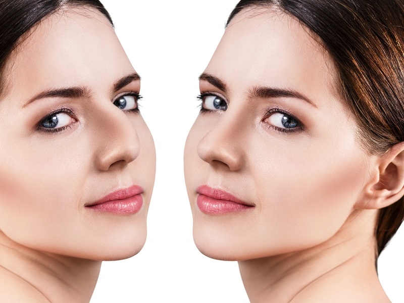 چند نوع عمل زیبایی بینی داریم؟ 7 4dc98431-f0bd-4cdb-b24c-ec69fbb784bf