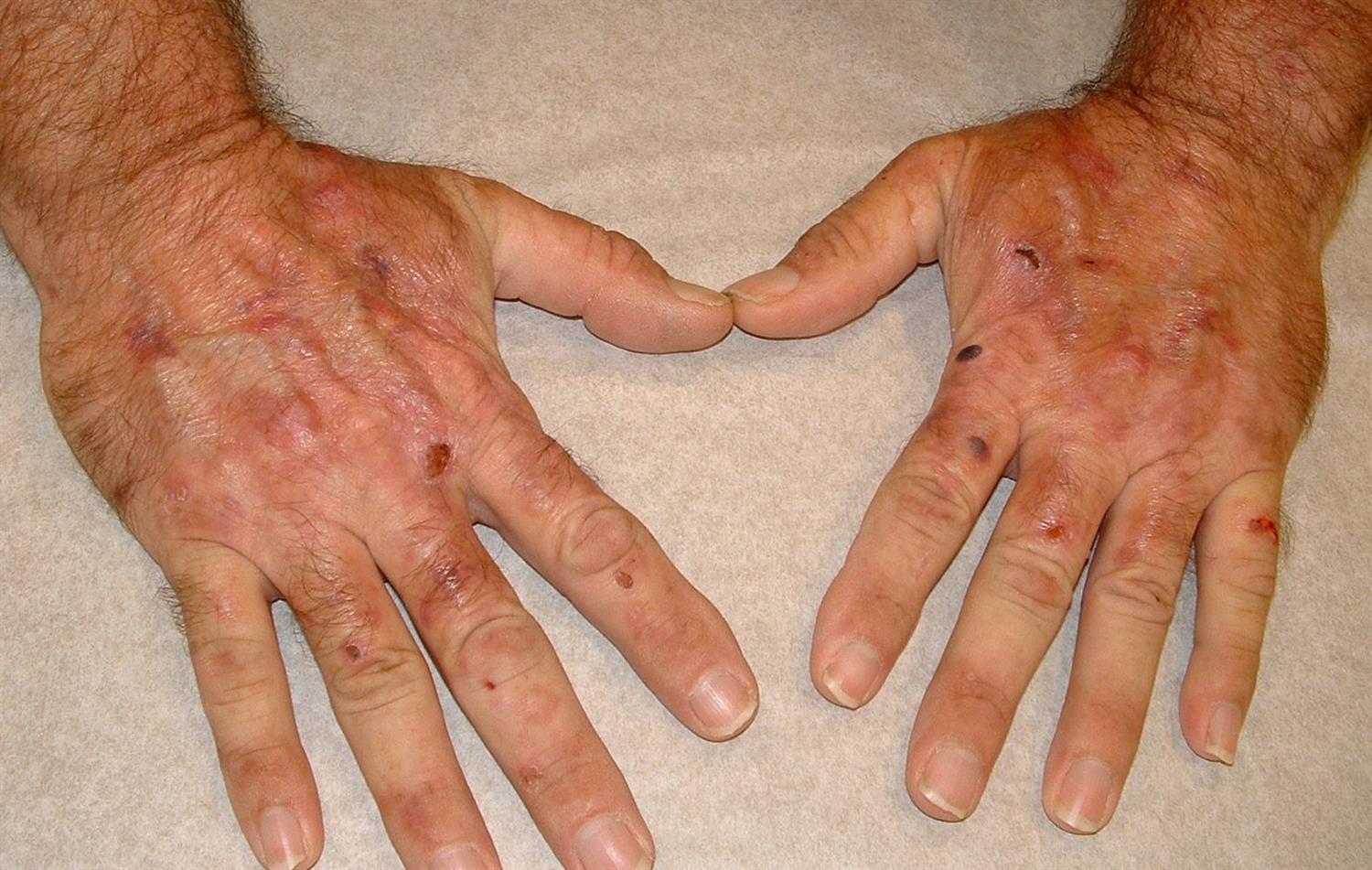 بیماری پورفیری