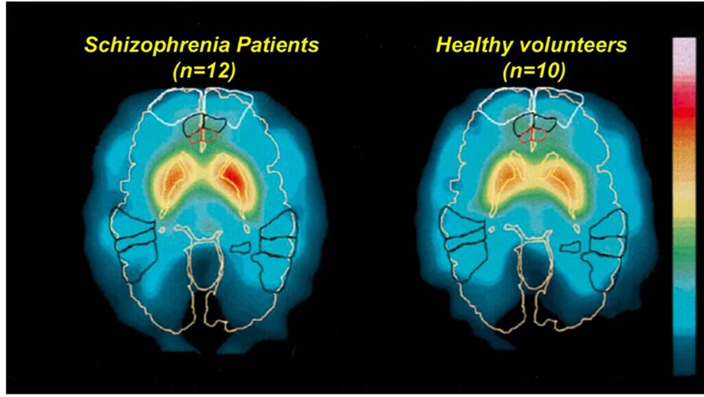 نخستین ابزار تشخیص اسکیزوفرنی با هوش مصنوعی در تایوان معارفه شد