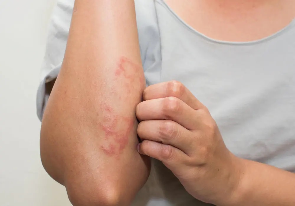 اگزما چیست؟ | علل، علائم، انواع، درمان و پیشگیری + تصاویر اگزما