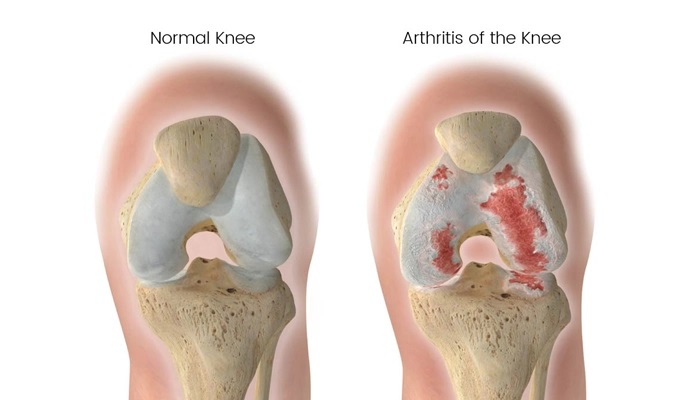 آرتروز چیست؟ | علائم، علل، درمان و راه حلهای پیشگیری