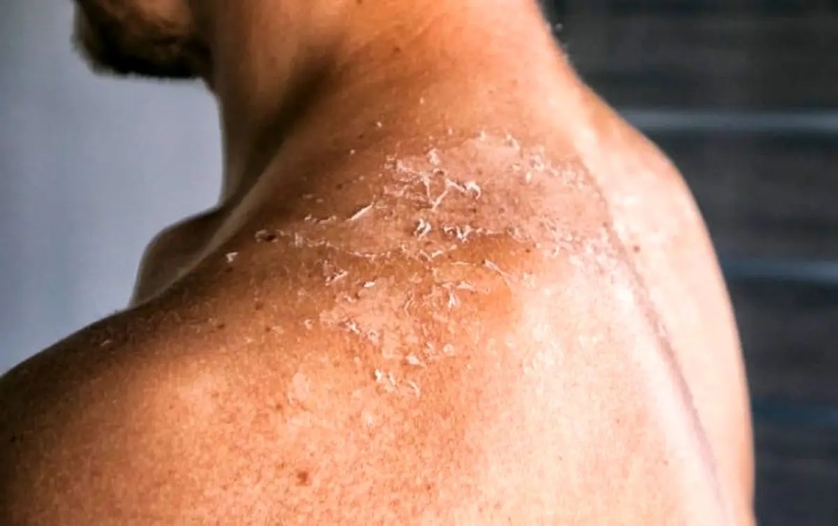 آفتاب سوختگی (4)