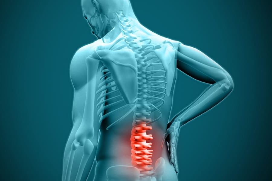 دیسک کمر|علائم، علت، درمان خانگی و دارویی + سوالات متداول