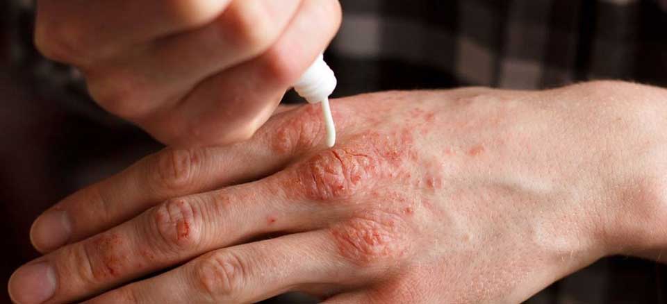 پسوریازیس (3)