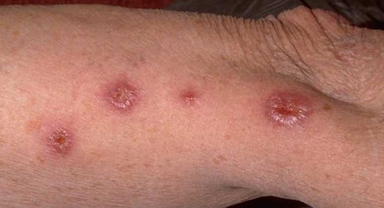 بیماری سالک چیست؟؛ علائم، درمان و پیشگیری